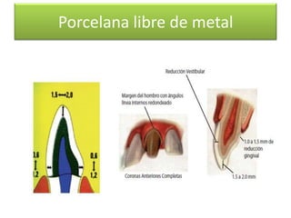 Porcelana libre de metal

 