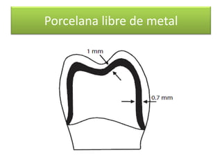 Porcelana libre de metal

 