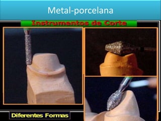 Metal-porcelana

 