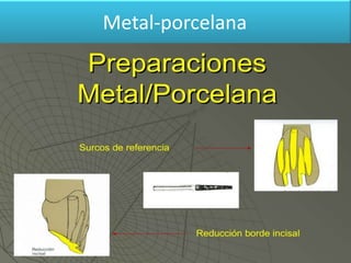 Metal-porcelana

 
