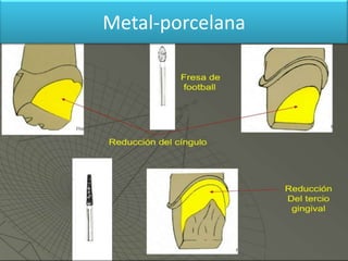 Metal-porcelana

 
