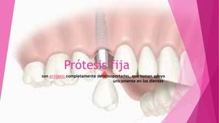 Prótesis fija
son prótesis completamente dentosoportadas, que toman apoyo
únicamente en los dientes.
 