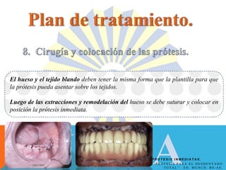 P R Ó T E S I S I N M E D I A T A S .
El hueso y el tejido blando deben tener la misma forma que la plantilla para que
la prótesis pueda asentar sobre los tejidos.
Luego de las extracciones y remodelación del hueso se debe suturar y colocar en
posición la prótesis inmediata.
B O U C H E R C . O . ‘ ‘ P R Ó T E S I S P A R A E L D E S D E N T A D O
T O T A L ’ ’ . E D . M U N C H . B S - A S .
 