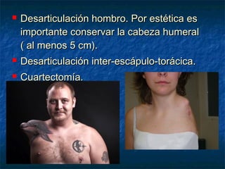 

Desarticulación hombro. Por estética es
importante conservar la cabeza humeral
( al menos 5 cm).



Desarticulación inter-escápulo-torácica.



Cuartectomía.

 