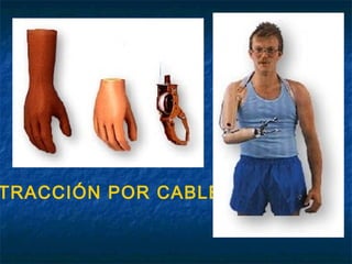 TRACCIÓN POR CABLE

 