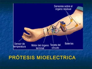 PRÓTESIS MIOELECTRICA

 