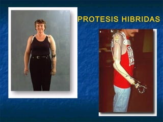 PROTESIS HIBRIDAS

 