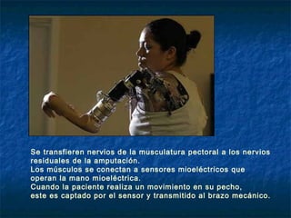 Se transfieren nervios de la musculatura pectoral a los nervios
residuales de la amputación.
Los músculos se conectan a sensores mioeléctricos que
operan la mano mioeléctrica.
Cuando la paciente realiza un movimiento en su pecho,
este es captado por el sensor y transmitido al brazo mecánico.

 