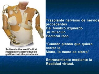 Trasplante nervioso de nervios
procedentes
Del hombro izquierdo
al músculo
Pectoral izdo.
“Cuando piensa que quiere
cerrar la
Mano, la mano se cierra”
Entrenamiento mediante la
Realidad virtual.

 