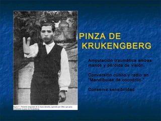 PINZA DE
KRUKENGBERG
Amputación traumática ambas
manos y pérdida de visión.
Conversión cúbito y radio en
“Mandíbulas de cocodrilo.”
Conserva sensibilidad

 