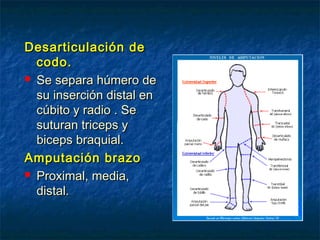 Desarticulación de
codo.
 Se separa húmero de
su inserción distal en
cúbito y radio . Se
suturan triceps y
biceps braquial.
Amputación brazo
 Proximal, media,
distal.

 