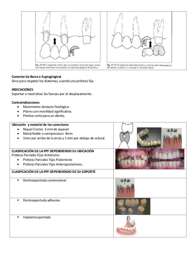 Prótesis parcial fija