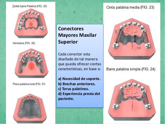 Prótesis parcial removible