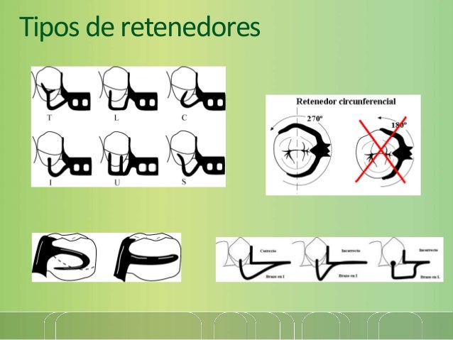 Prótesis Parcial Removible