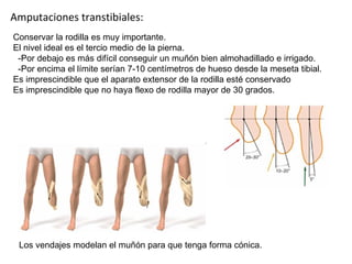 Amputaciones transtibiales: Conservar la rodilla es muy importante. El nivel ideal es el tercio medio de la pierna.  -Por ...