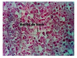 Bacilo de koch
 