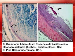 C) Granuloma tuberculoso: Presencia de bacilos ácido
alcohol resistentes (flechas). Ziehl-Neelssen. 40x;
D) Piel: Ulcera tuberculosa. H&E.
 