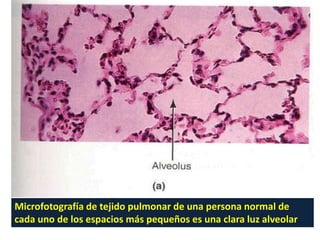 Microfotografía de tejido pulmonar de una persona normal de
cada uno de los espacios más pequeños es una clara luz alveolar.
 