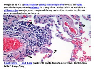 Emphysema_H_and_E.jpg (528 x 393 pixels, tamaño de archivo: 102 KB, tipo
MIME: image/jpeg)
Imagen es de h & E (hematoxilina y eosina) teñido de pulmón muestra del tejido
tomado de un paciente de enfisema de la etapa final. Núcleo celular es azul violeta,
glóbulos rojos son rojas, otros cuerpos celulares y material extracelular son de color
rosas y espacios de aire son blancos.
 