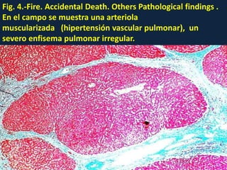 Fig. 4.-Fire. Accidental Death. Others Pathological findings .
En el campo se muestra una arteriola
muscularizada (hipertensión vascular pulmonar), un
severo enfisema pulmonar irregular.
 