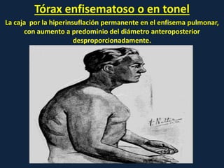 Tórax enfisematoso o en tonel
La caja por la hiperinsuflación permanente en el enfisema pulmonar,
con aumento a predominio del diámetro anteroposterior
desproporcionadamente.
 