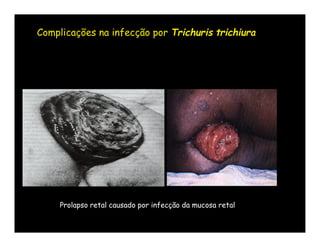 Complicações na infecção por Trichuris trichiura




     Prolapso retal causado por infecção da mucosa retal
 