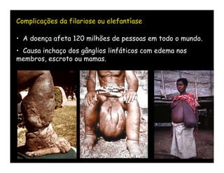 Complicações da filariose ou elefantíase

• A doença afeta 120 milhões de pessoas em todo o mundo.
• Causa inchaço dos gânglios linfáticos com edema nos
membros, escroto ou mamas.
 