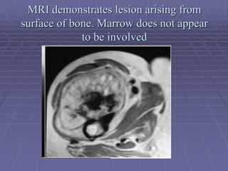 MRI demonstrates lesion arising from
surface of bone. Marrow does not appear
to be involved
 
