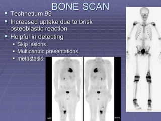 BONE SCAN
 Technetium 99
 Increased uptake due to brisk
osteoblastic reaction
 Helpful in detecting
 Skip lesions
 Multicentric presentations
 metastasis
 