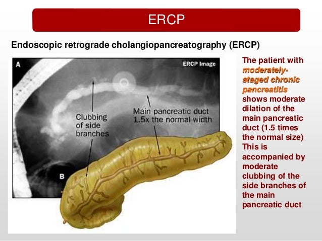 Chronic Pancreatitis
