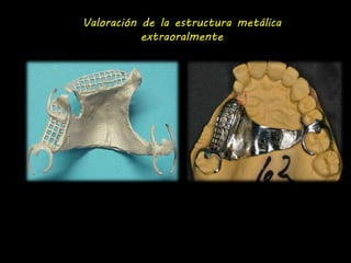 Valoración de la estructura metálica 
extraoralmente 
 
