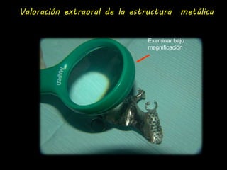 Valoración extraoral de la estructura metálica 
Examinar bajo 
magnificación 
 