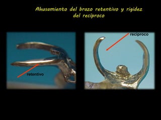 Ahusamiento del brazo retentivo y rigidez 
del recíproco 
retentivo 
reciproco 
 