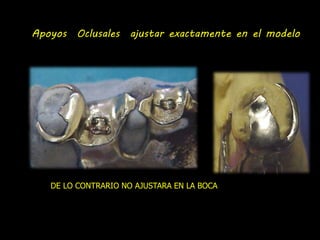 Apoyos Oclusales ajustar exactamente en el modelo 
DE LO CONTRARIO NO AJUSTARA EN LA BOCA 
 
