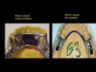 Placa Lingual 
Intimo contacto 
. 
Barra Lingual 
No contacto 
 