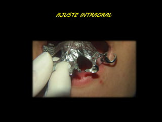 AJUSTE INTRAORAL 
 