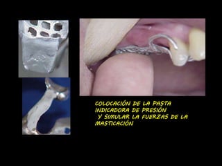 COLOCACIÓN DE LA PASTA 
INDICADORA DE PRESIÓN 
Y SIMULAR LA FUERZAS DE LA 
MASTICACIÓN 
 