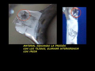 MATERIAL INDICANDO LA PRESIÓN 
CON LOS TEJIDOS, ELIMINAR INTERFERENCIA 
CON FRESA 
 