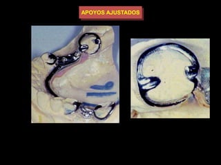 APOYOS AJUSTADOS 
Diseño. 
Es necesario que tenga 2 apoyos. 
Las áreas de socavado deben estar en mesio vestibular para 
los superiores y mesio lingual para los inferiores. 
 