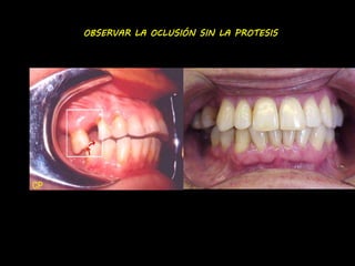 OBSERVAR LA OCLUSIÓN SIN LA PROTESIS 
 