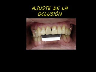 AJUSTE DE LA 
OCLUSIÓN 
 