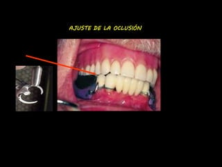 AJUSTE DE LA OCLUSIÓN 
 