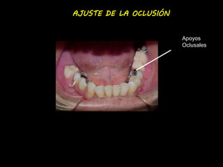 AJUSTE DE LA OCLUSIÓN 
Apoyos 
Oclusales 
 