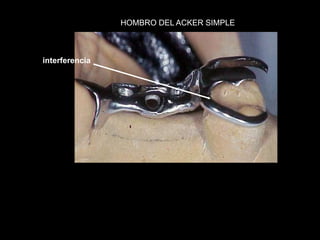 interferencia 
HOMBRO DEL ACKER SIMPLE 
 