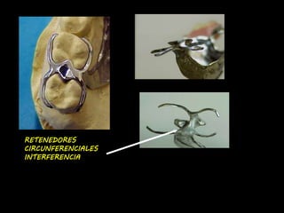 RETENEDORES 
CIRCUNFERENCIALES 
INTERFERENCIA 
 