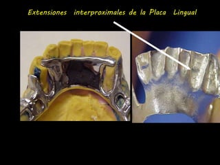Extensiones interproximales de la Placa Lingual 
 
