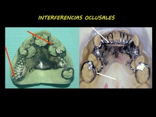 INTERFERENCIAS OCLUSALES 
 