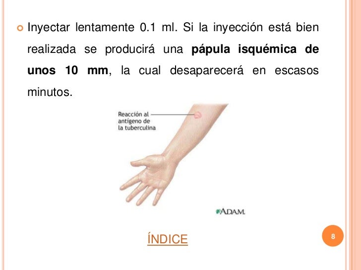 Prueba de la tuberculina Prueba de la tuberculina