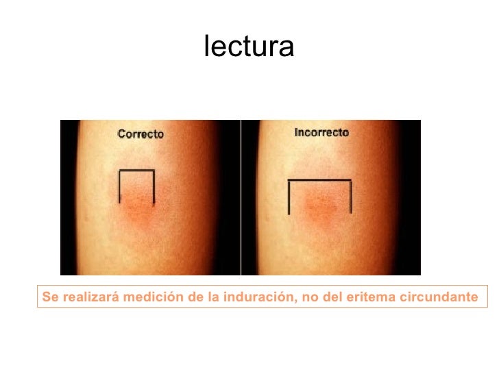 Prueba De Mantoux