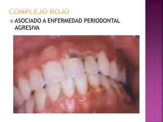  ASOCIADO A ENFERMEDAD PERIODONTAL
AGRESIVA
 